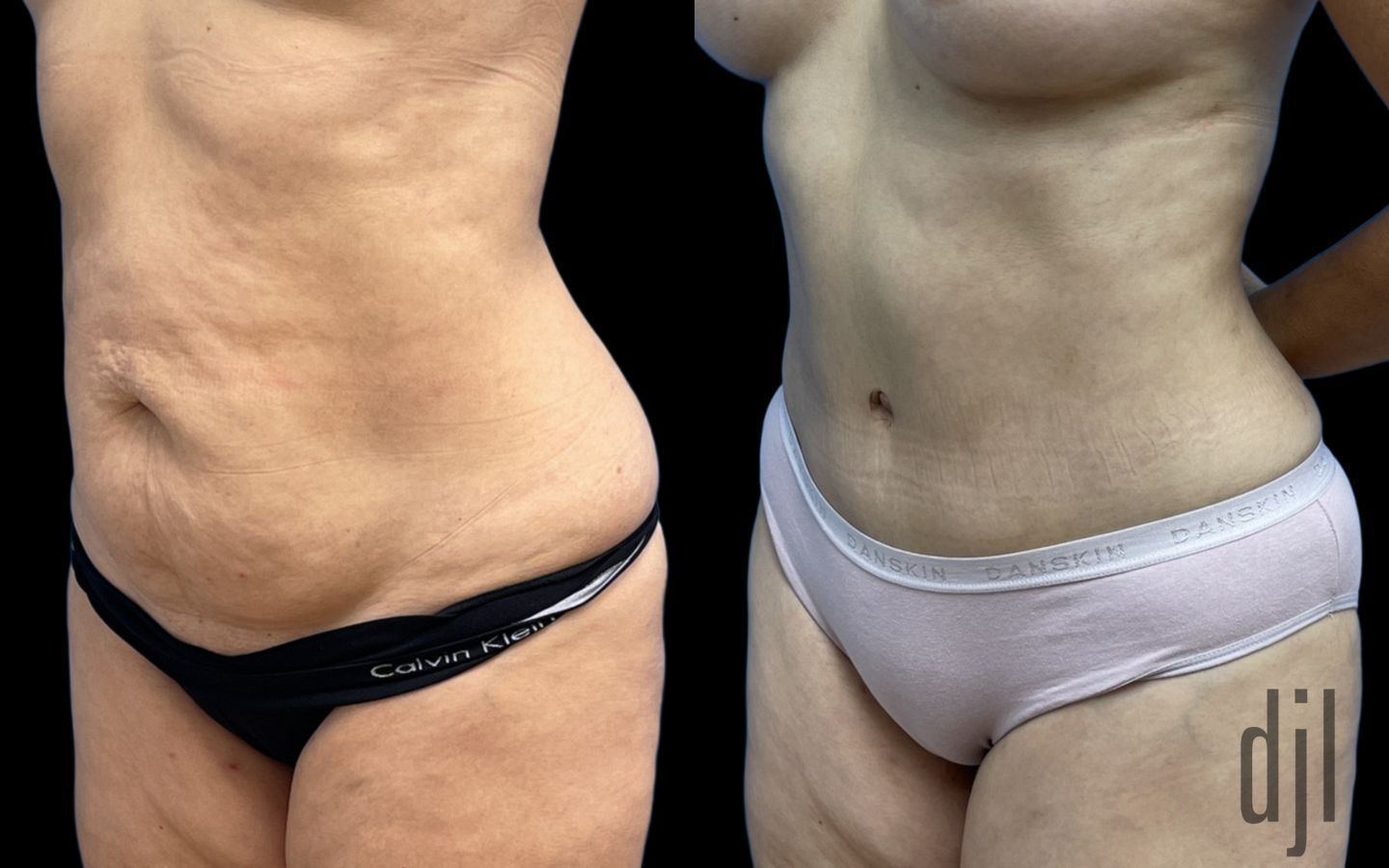 Before and after Tummy Tuck case 41348 - Angle 2