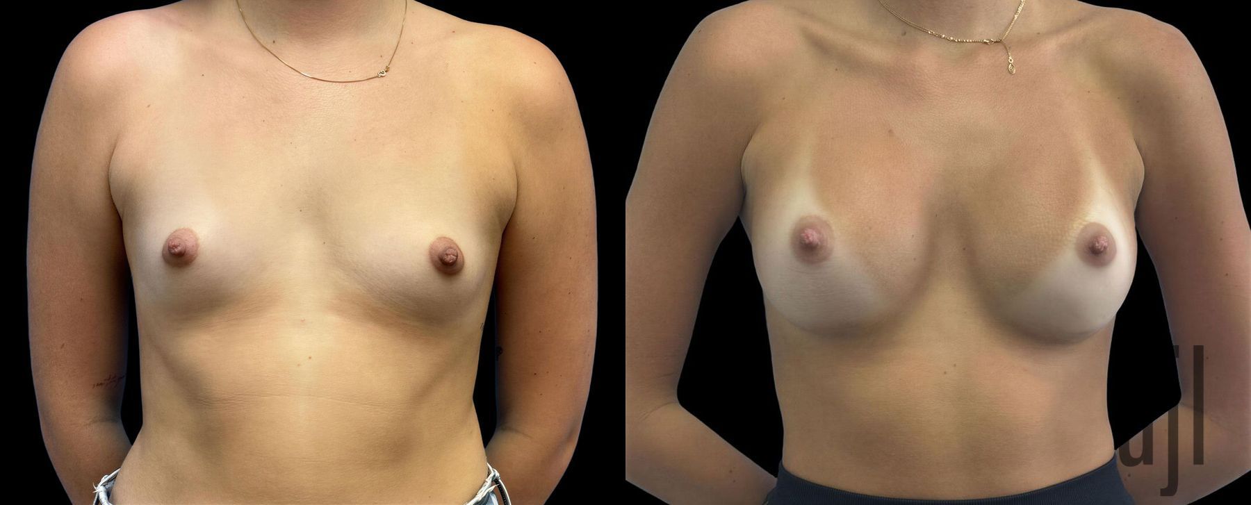 Before and after Breast Augmentation case 43048