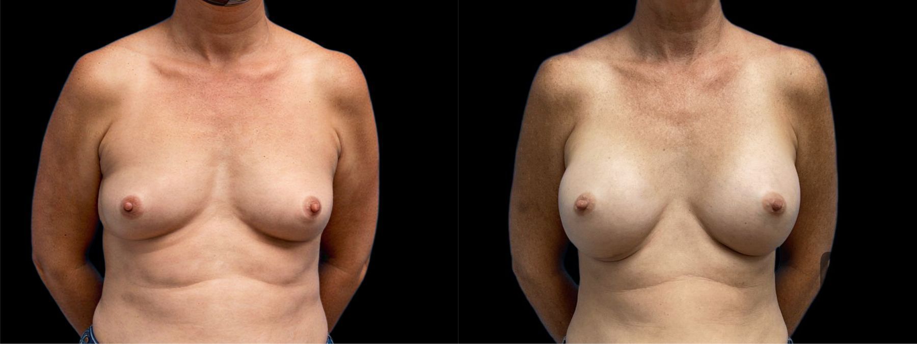 Before and after Breast Augmentation case 41241