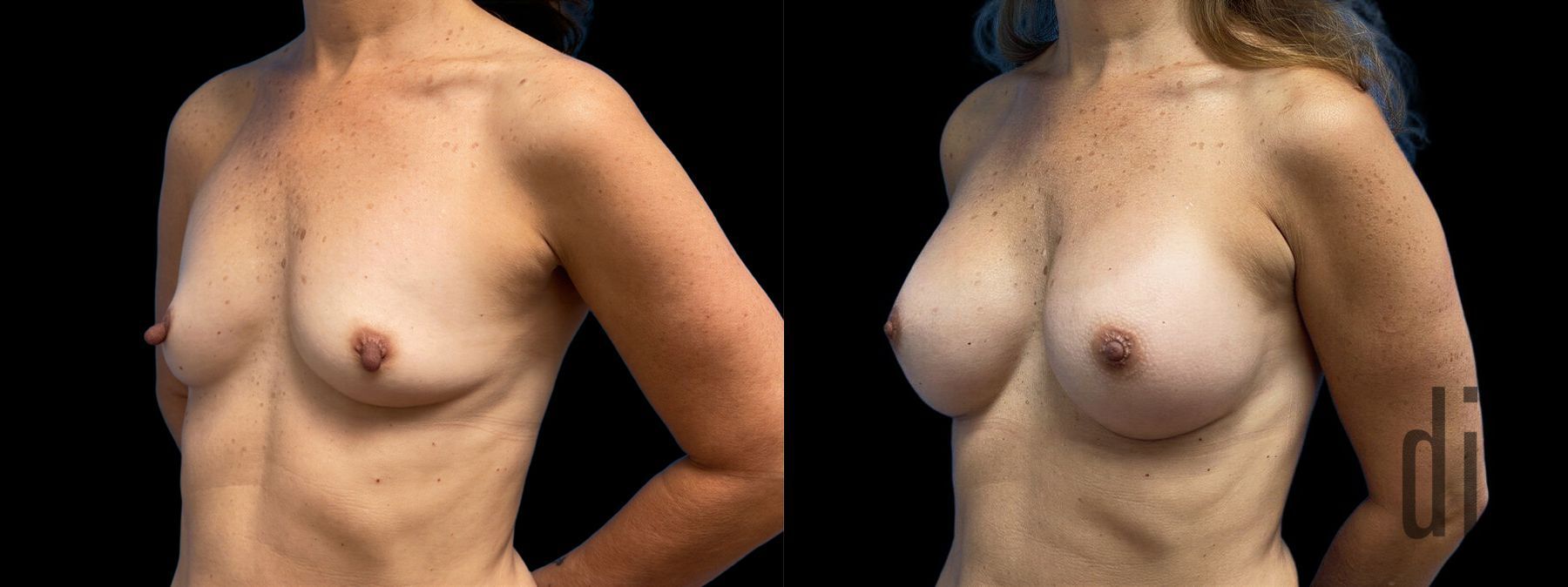 Before and after Breast Augmentation case 41239 - Angle 2