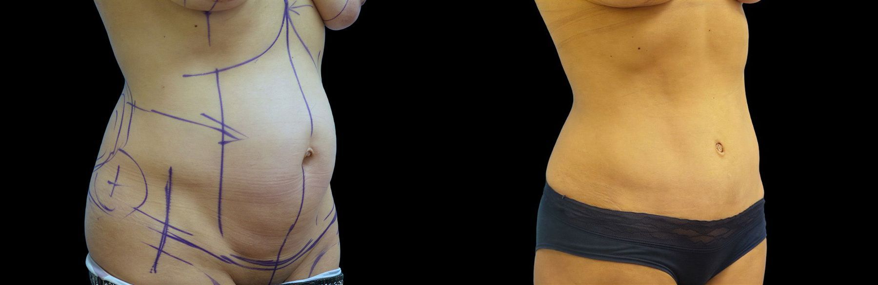 Before and after Tummy Tuck case 42903 - Angle 2