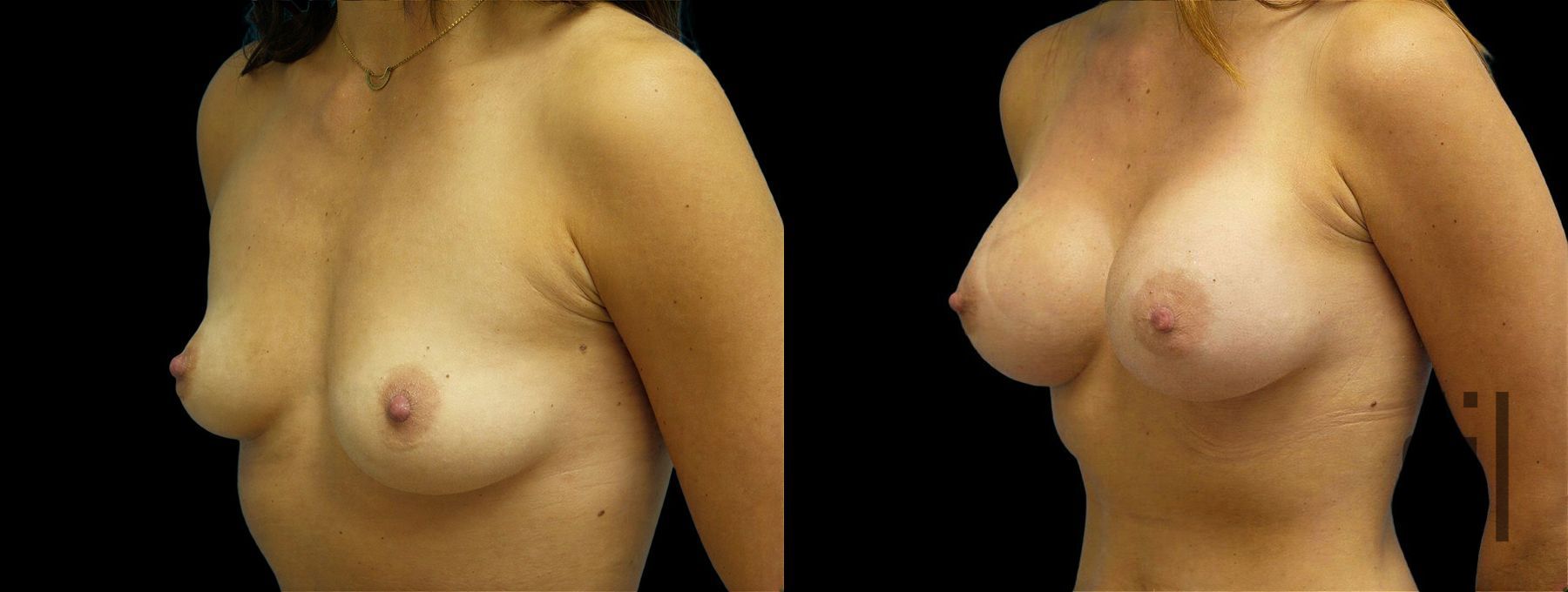 Before and after Breast Augmentation case 42998 - Angle 2
