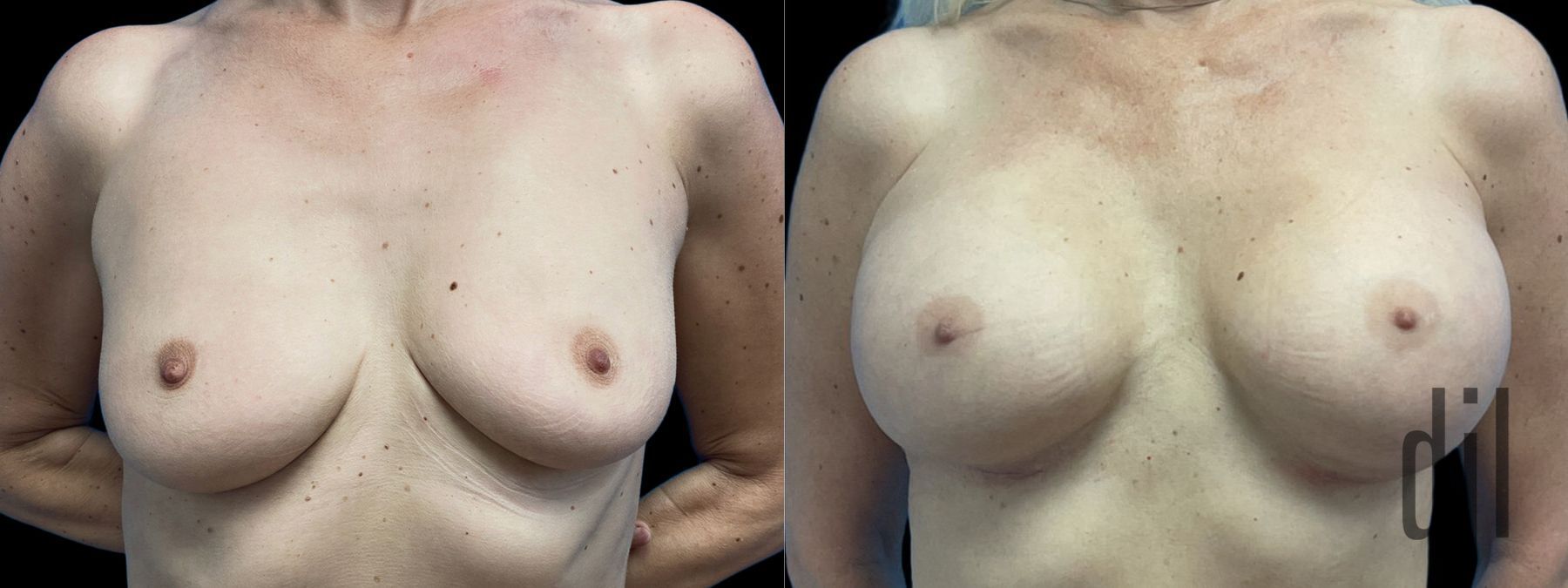 Before and after Breast Augmentation case 41240