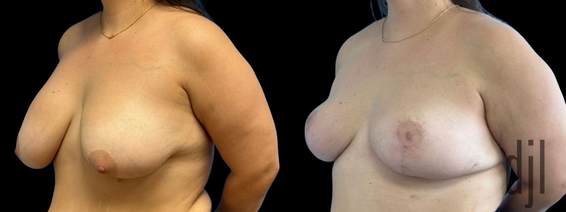Before and after Explant Mastopexy case 33062 - Angle 2