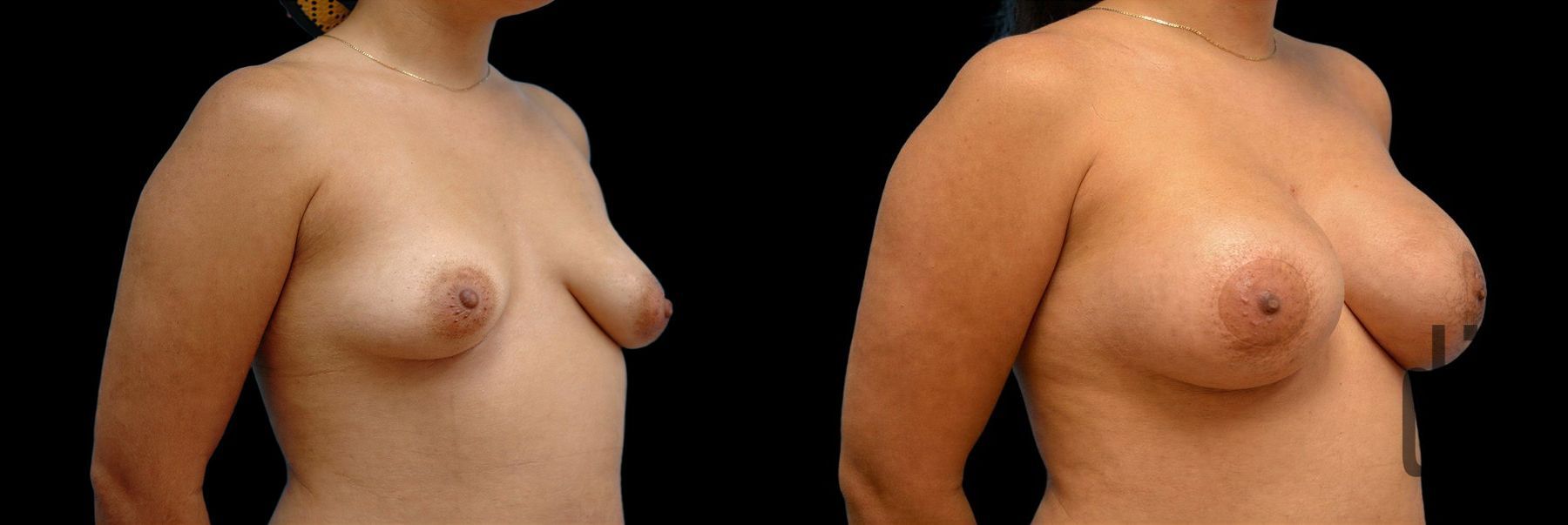 Before and after Breast Augmentation with Lift case 42701 - Angle 2