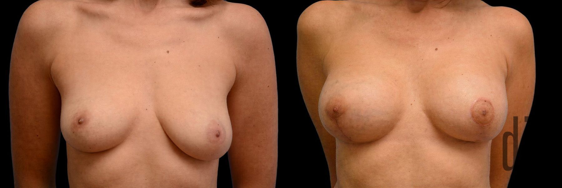 Before and after Breast Augmentation with Lift case 42758