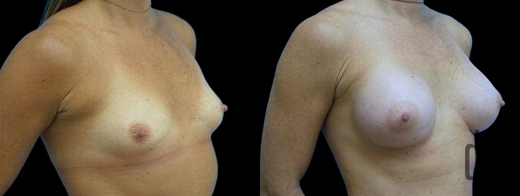 Before and after Breast Augmentation case 42949 - Angle 2