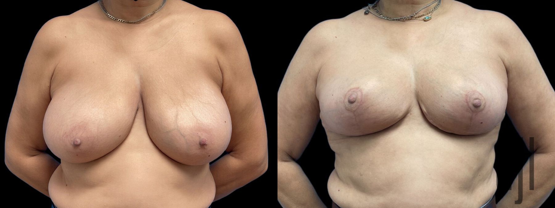 Before and after Breast Reduction case 41235