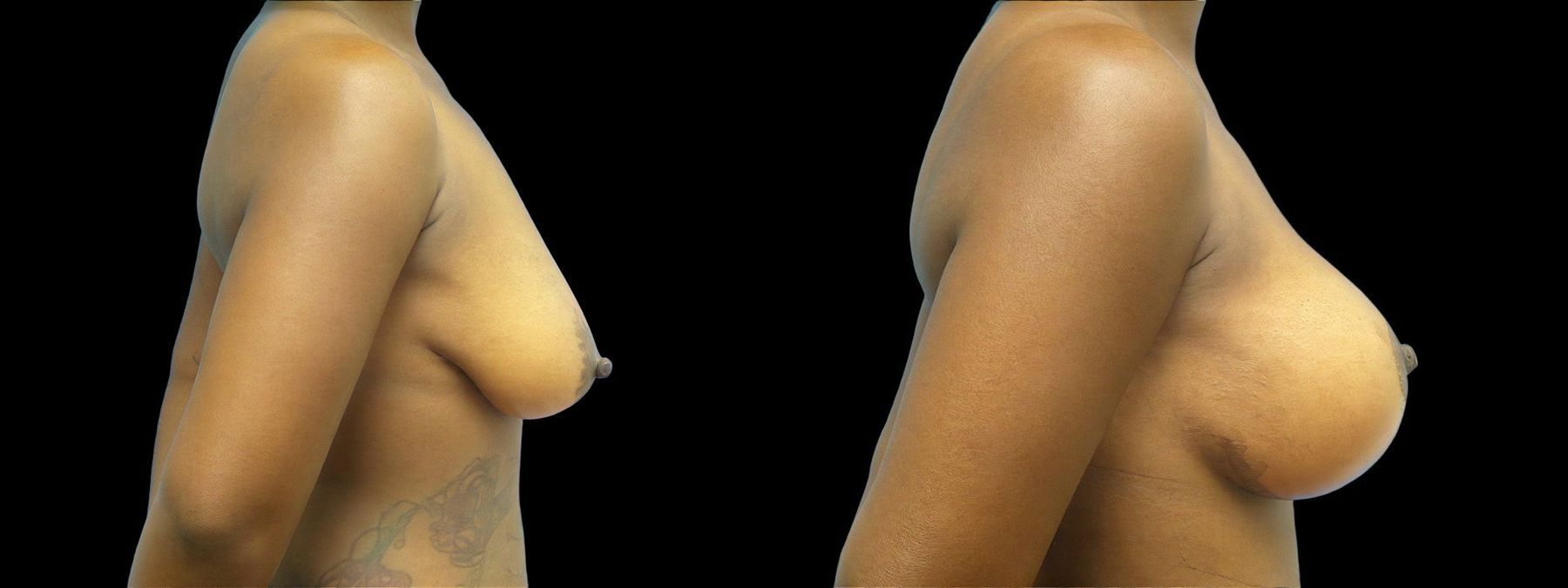 Before and after Breast Augmentation with Lift case 42914 - Angle 2