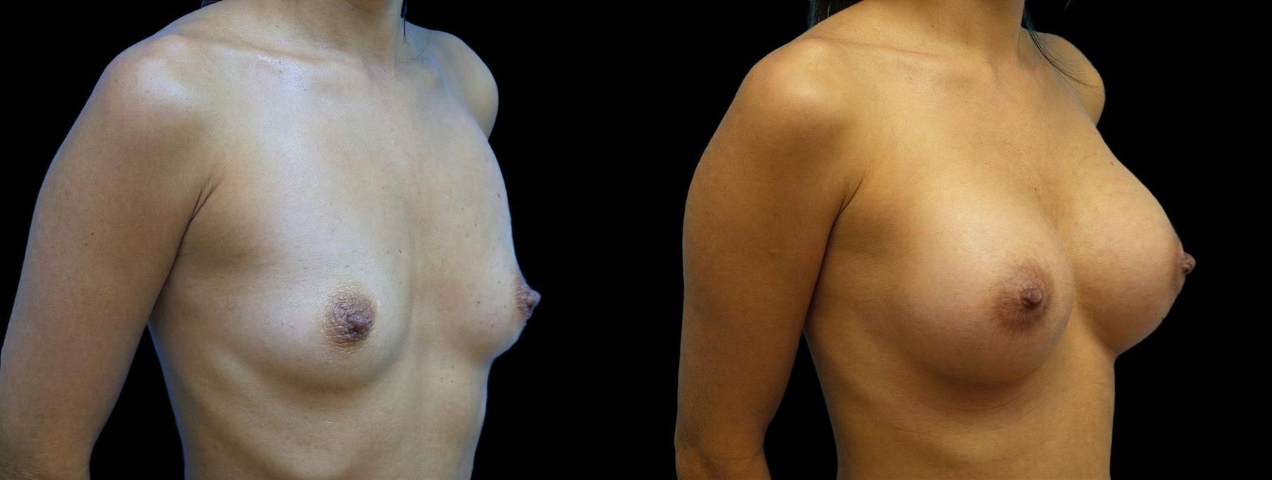 Before and after Breast Augmentation case 42945 - Angle 2
