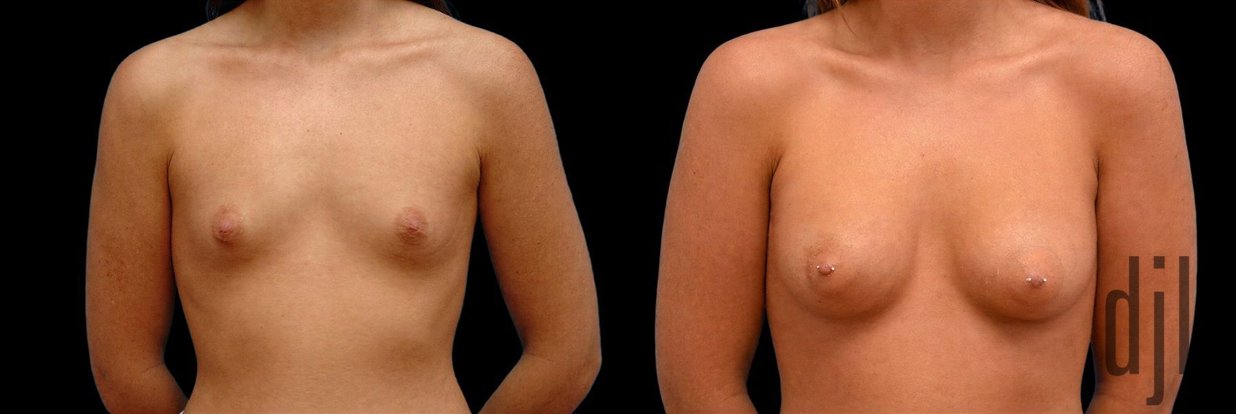 Before and after Breast Augmentation case 42803