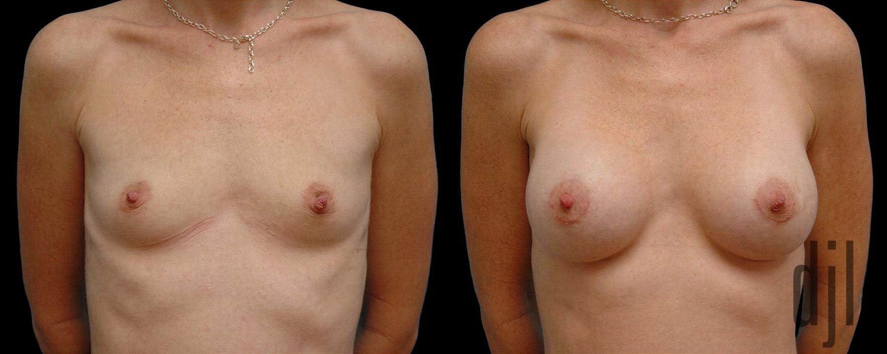 Before and after Breast Augmentation case 42744
