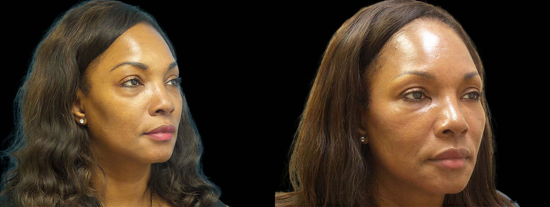 Before and after Suborbital / Tear Trough case 42584