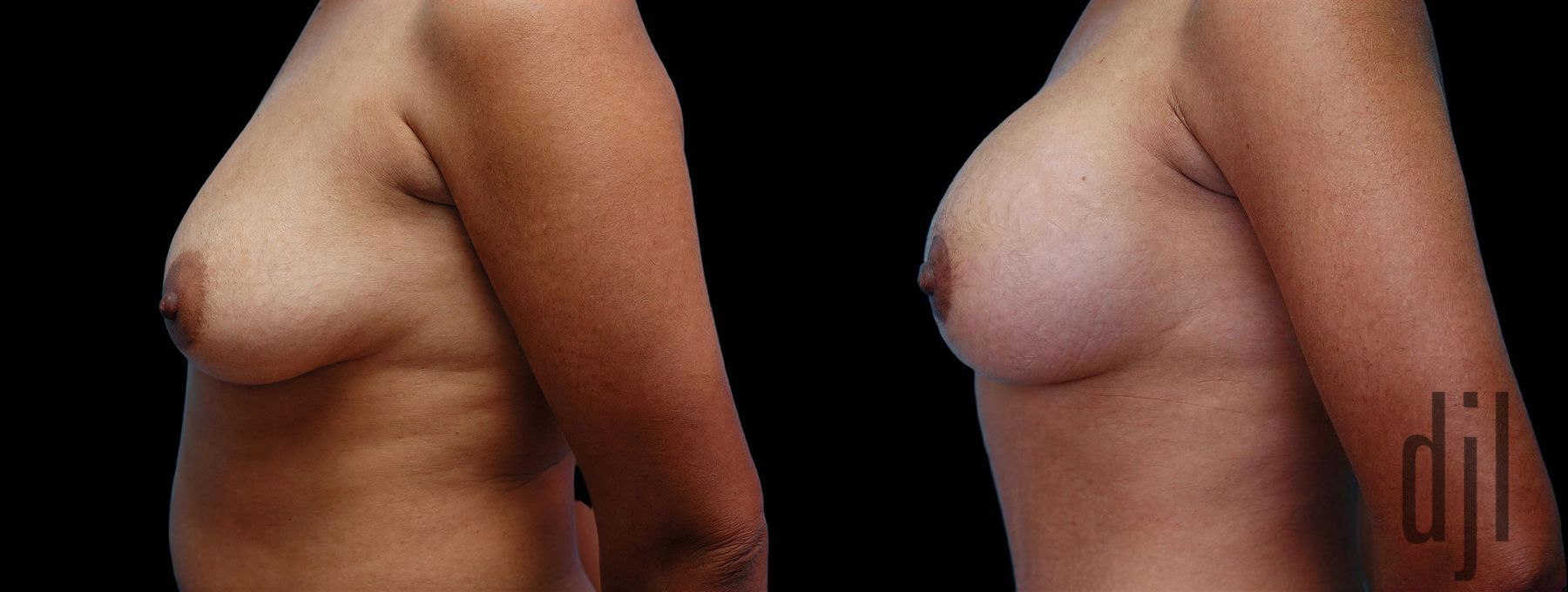 Before and after Breast Augmentation with Lift case 42564 - Angle 2