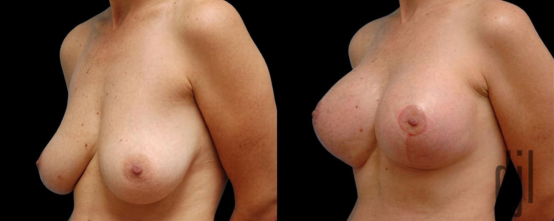 Before and after Breast Augmentation with Lift case 42689