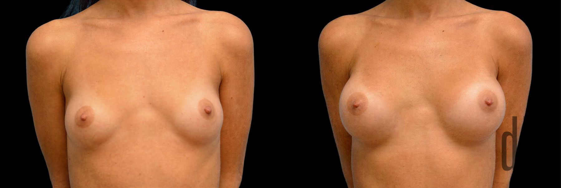 Before and after Breast Augmentation case 42863
