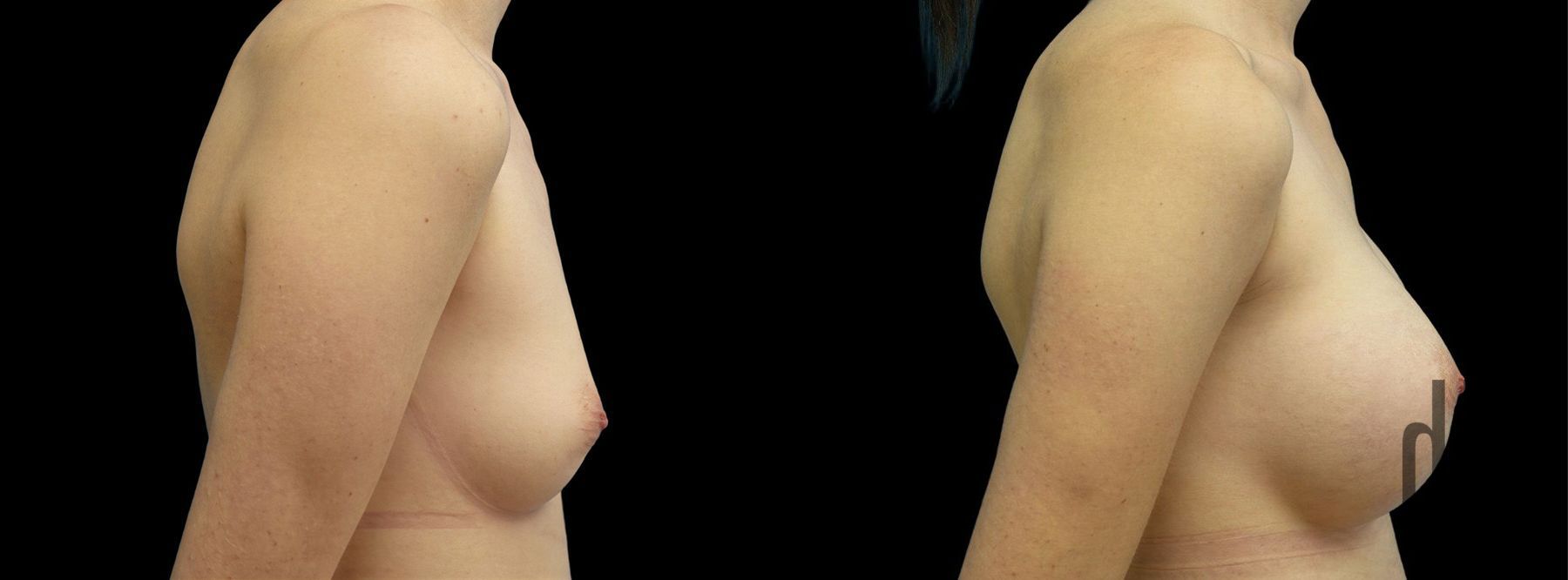Before and after Breast Augmentation case 42967 - Angle 2