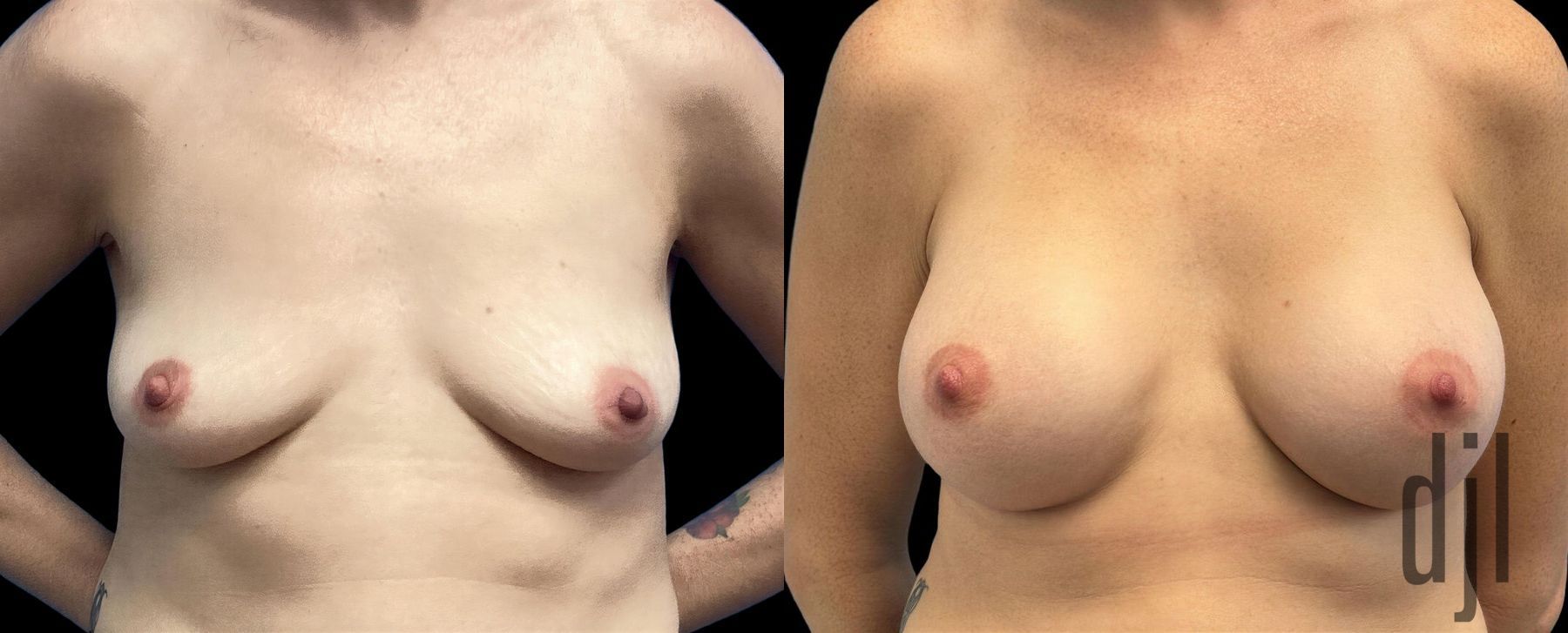 Before and after Breast Augmentation case 43047