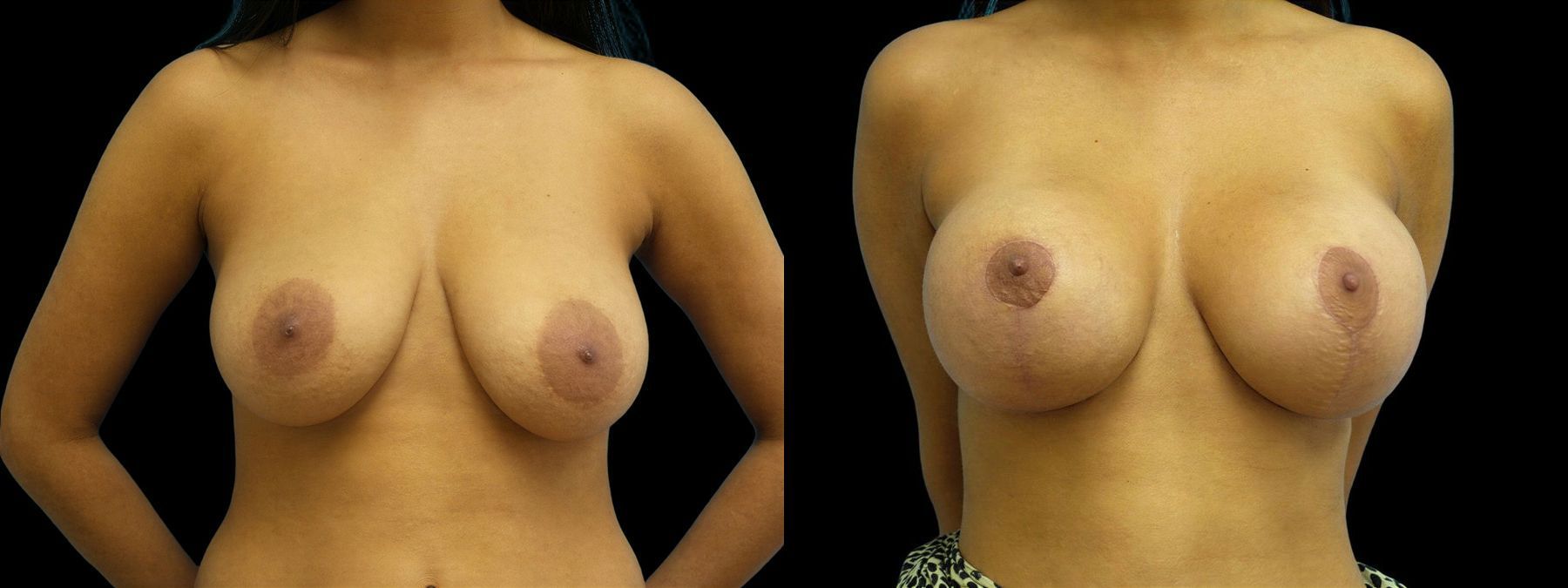 Before and after Breast Augmentation with Lift case 42922