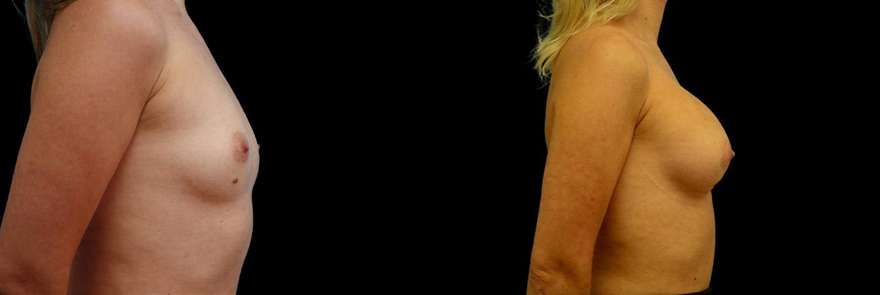 Before and after Breast Augmentation case 42785 - Angle 2