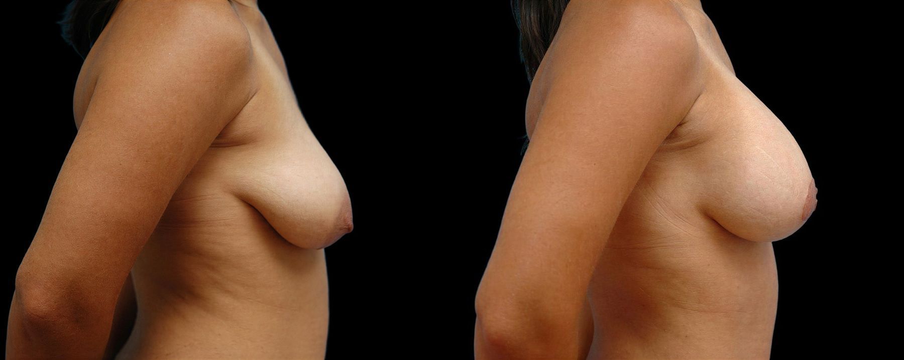 Before and after Breast Augmentation with Lift case 42600 - Angle 2