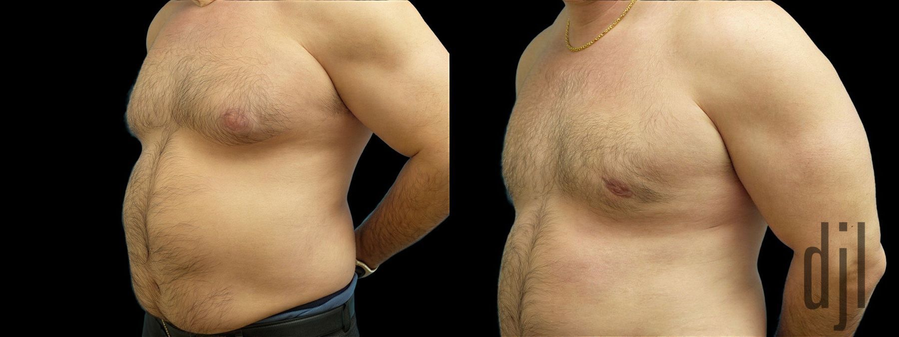 Before and after Gynecomastia case 42824 - Angle 2