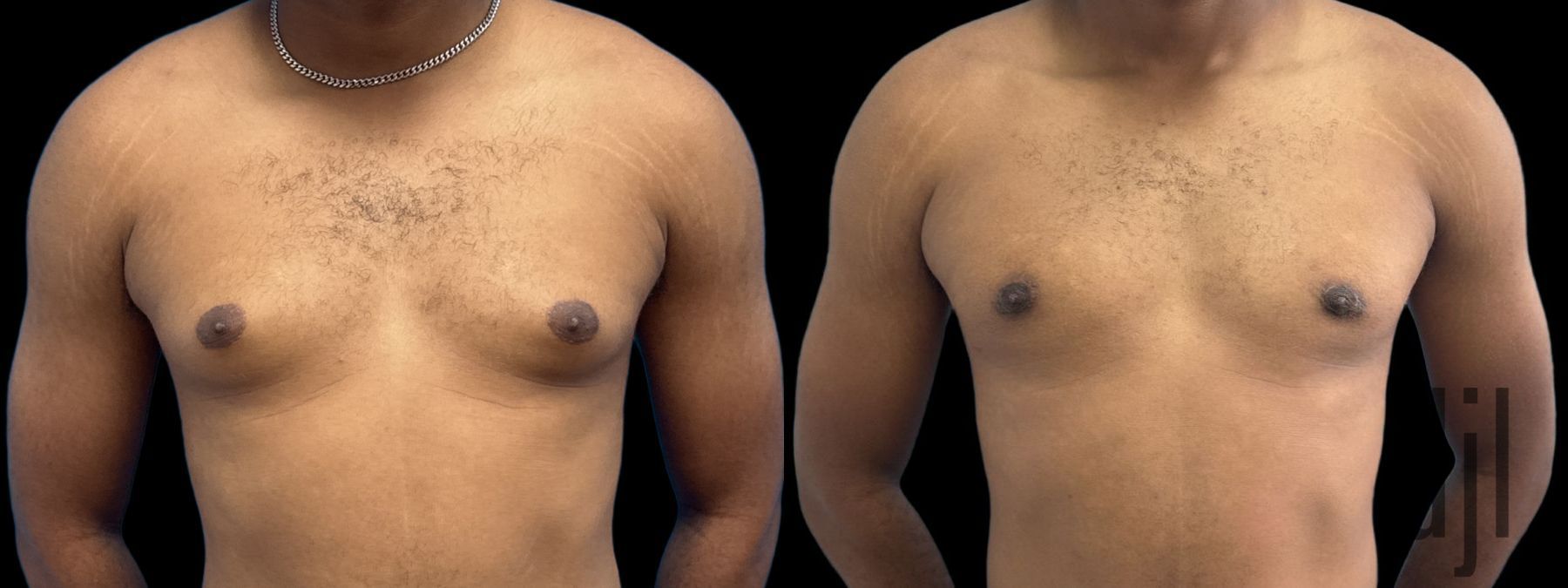Before and after Gynecomastia case 37379