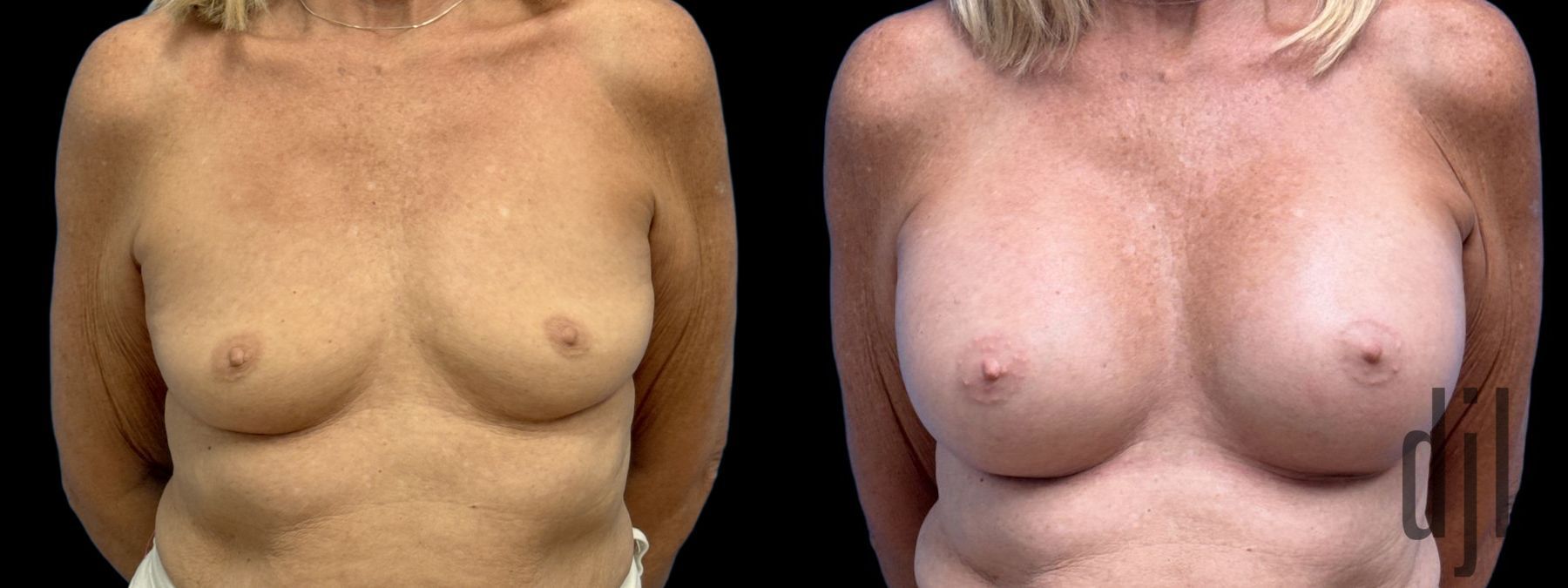 Before and after Breast Augmentation case 33058