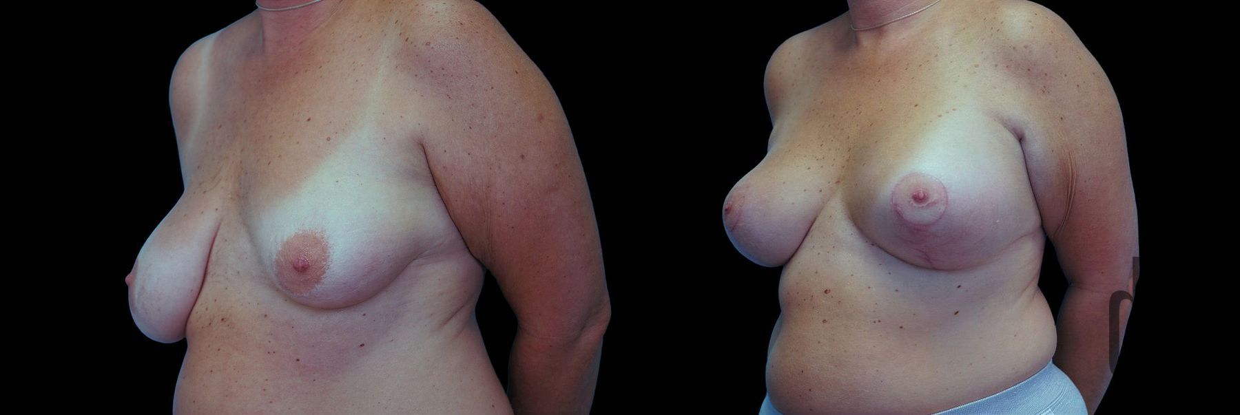 Before and after Breast Augmentation with Lift case 42830 - Angle 2