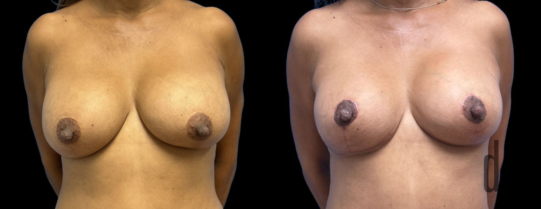 Before and after Implant Replacement Mastopexy case 33064