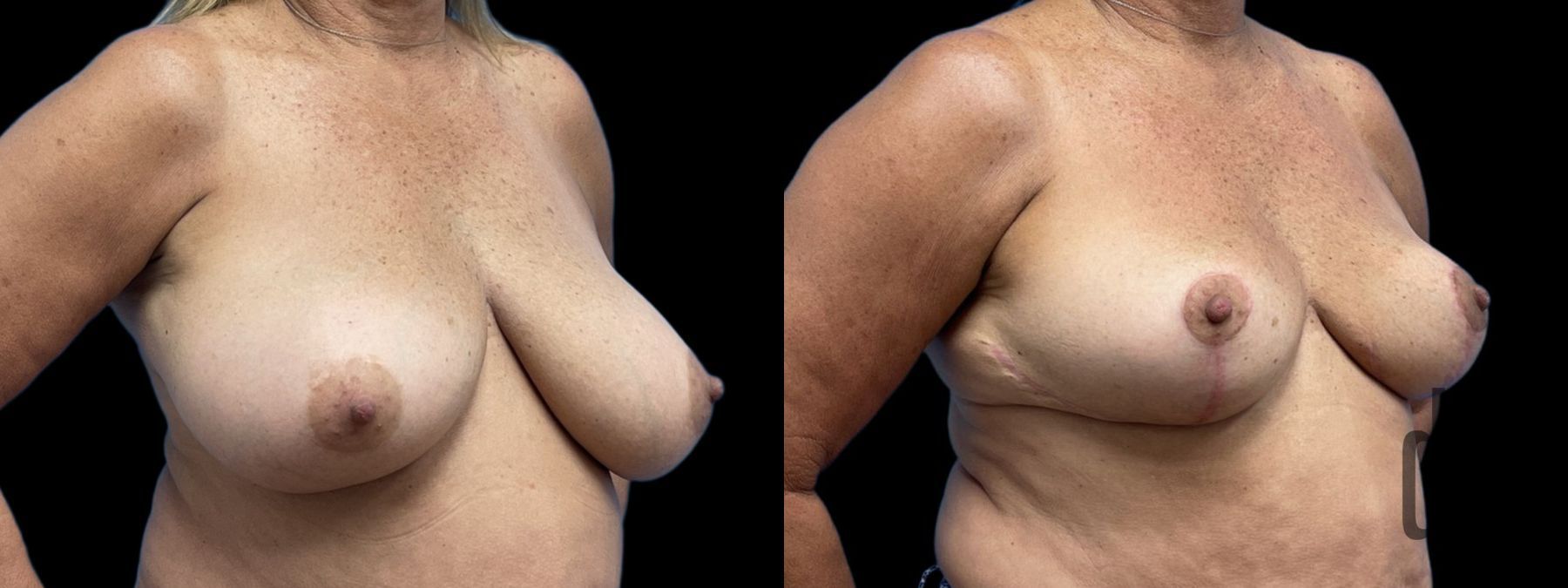 Before and after Breast Reduction case 41234 - Angle 2