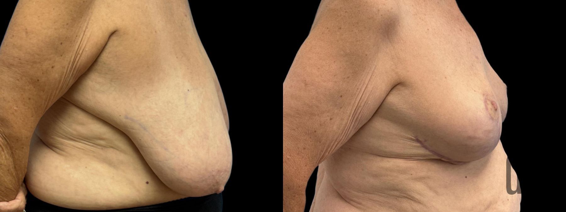 Before and after Breast Reduction case 33061 - Angle 2