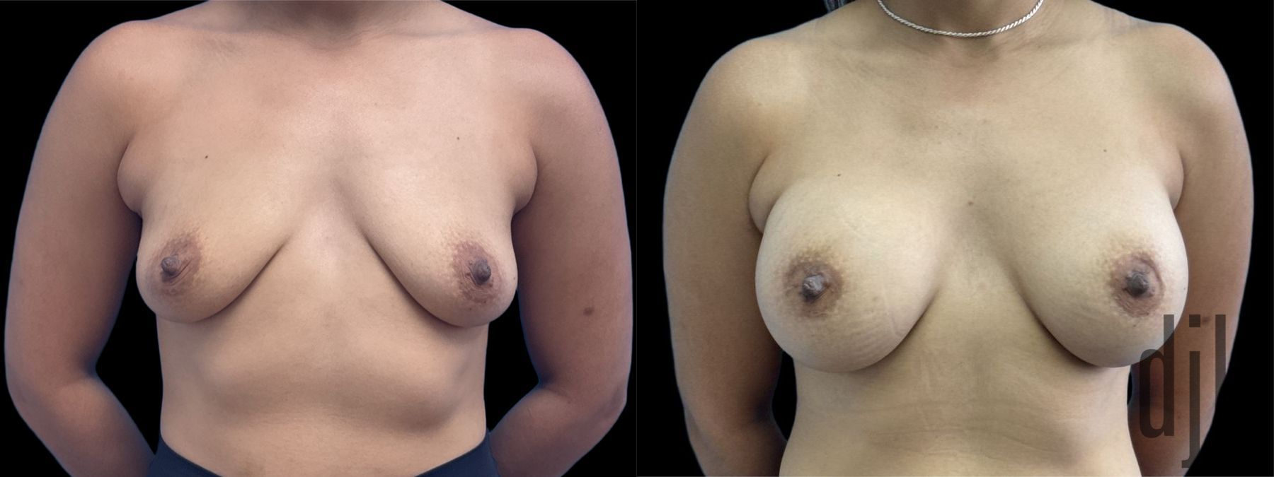 Before and after Breast Augmentation case 37383