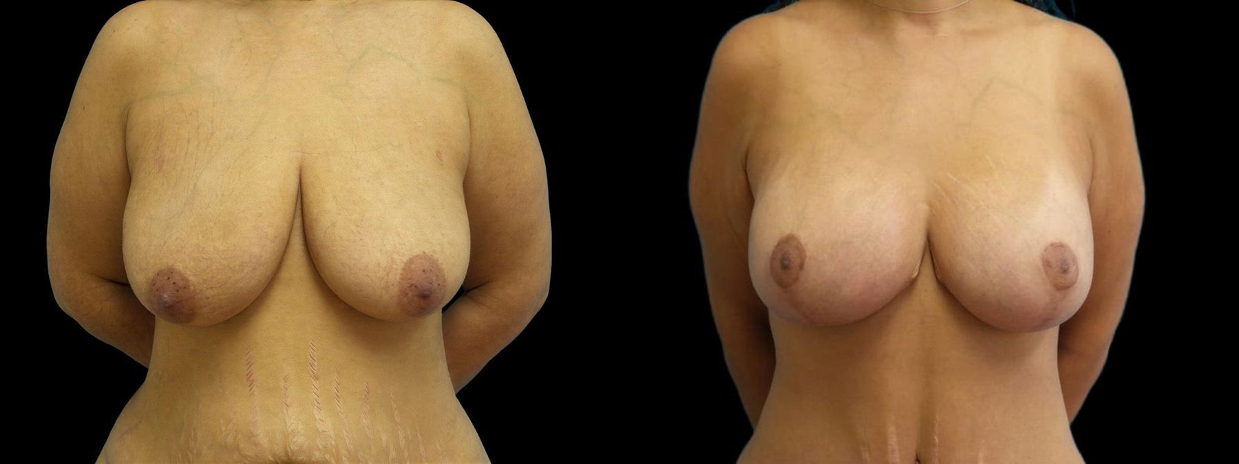 Before and after Breast Augmentation with Lift case 42948