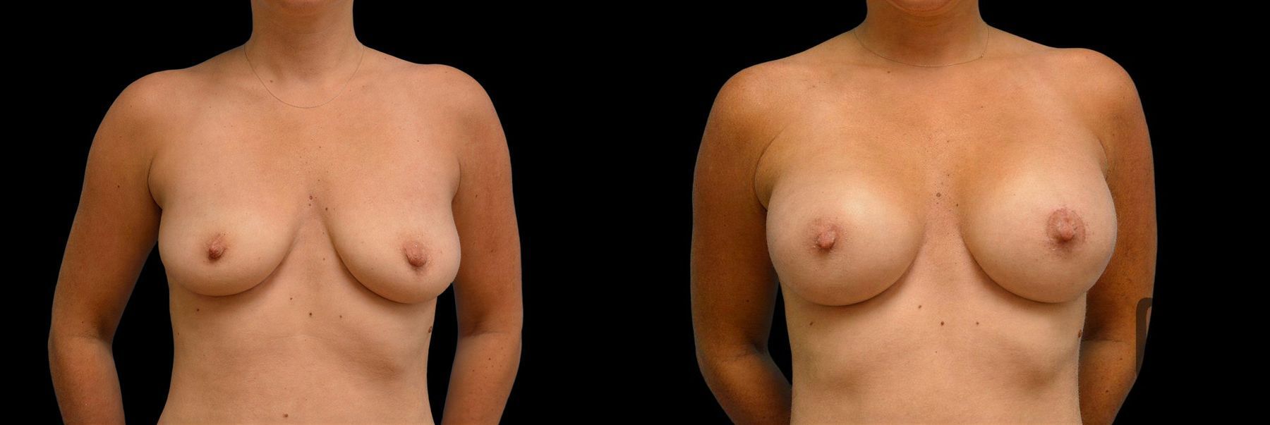 Before and after Breast Augmentation case 42892