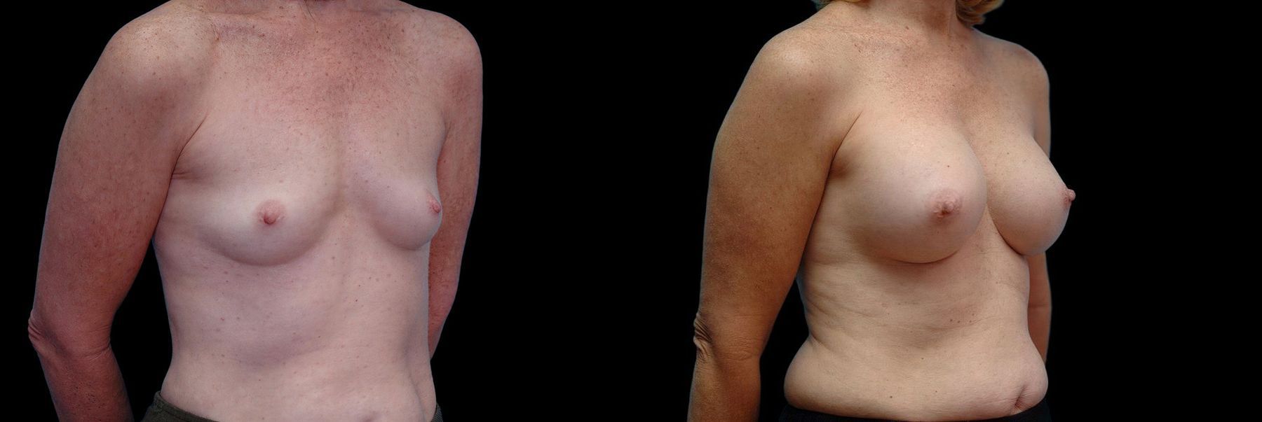 Before and after Breast Augmentation case 42706 - Angle 2