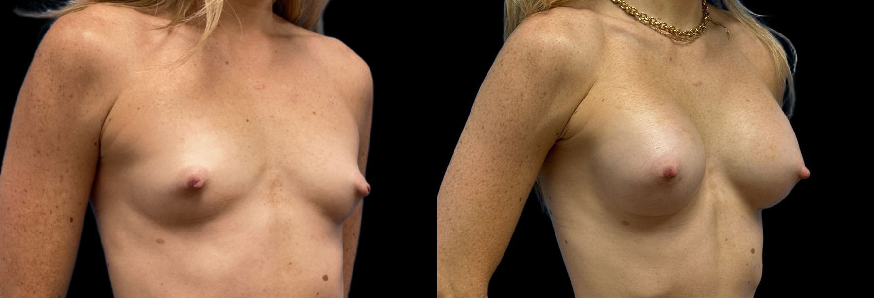 Before and after Breast Augmentation case 41242 - Angle 2