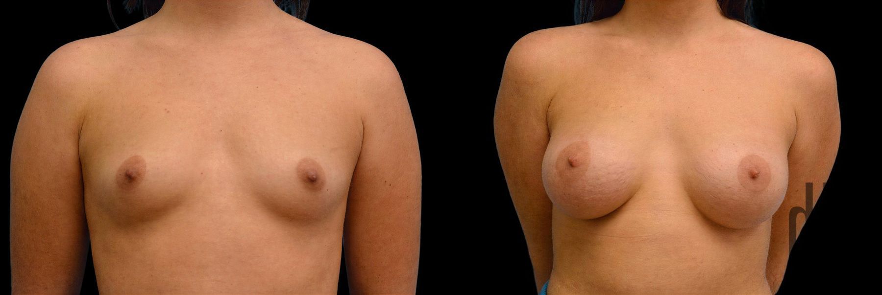 Before and after Breast Augmentation case 42913