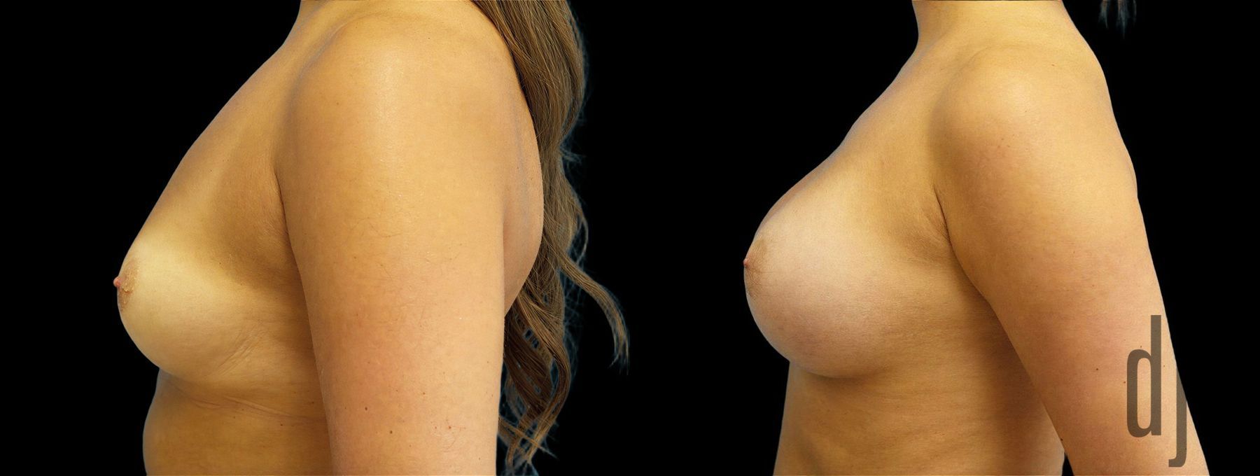 Before and after Breast Augmentation case 43000 - Angle 2
