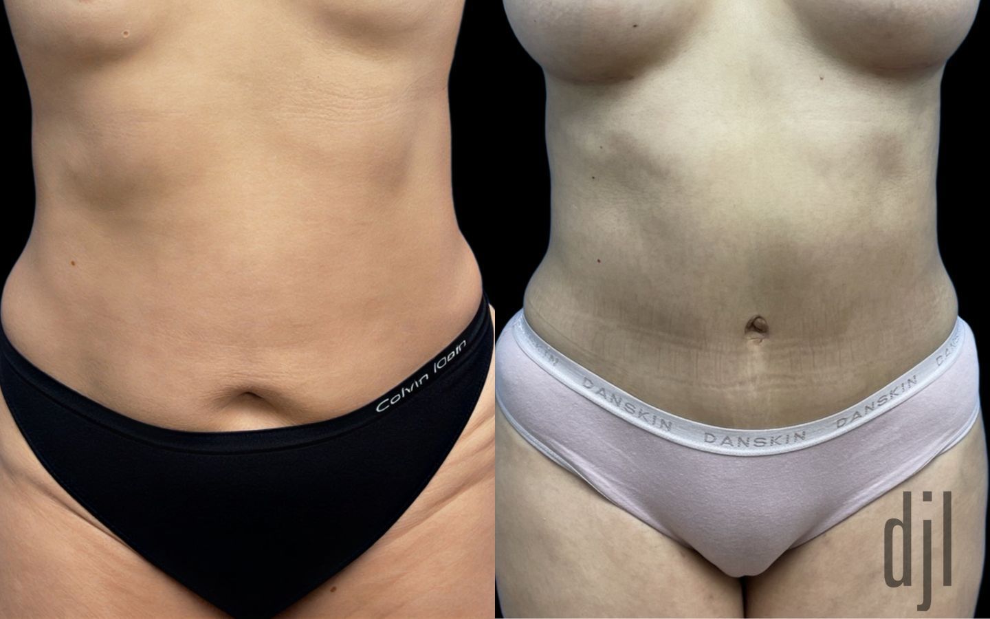 Before and after Tummy Tuck case 41348