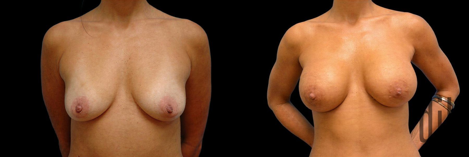 Before and after Breast Augmentation case 42840