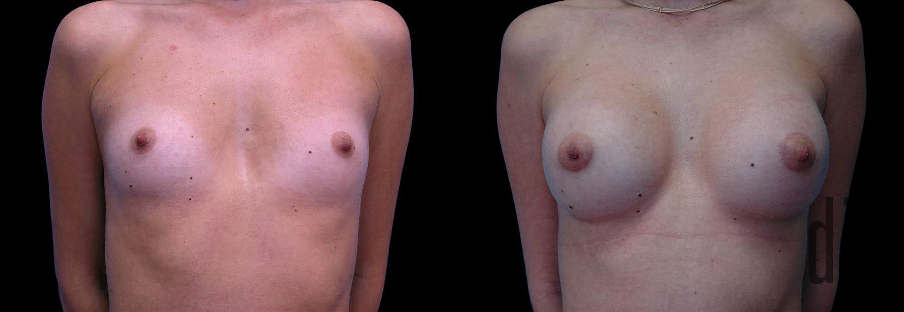 Before and after Breast Augmentation case 42679