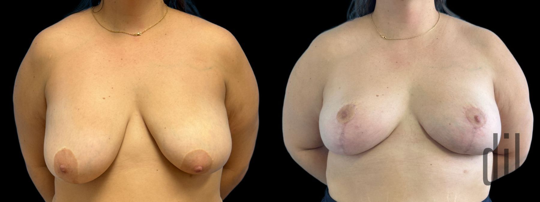 Before and after Explant Mastopexy case 33062