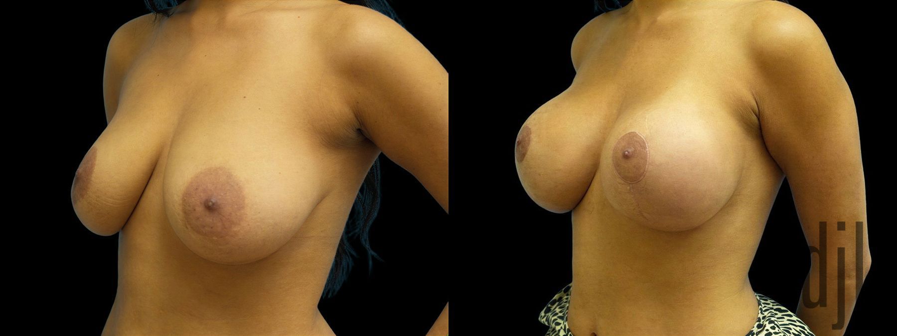 Before and after Breast Augmentation with Lift case 42922 - Angle 2
