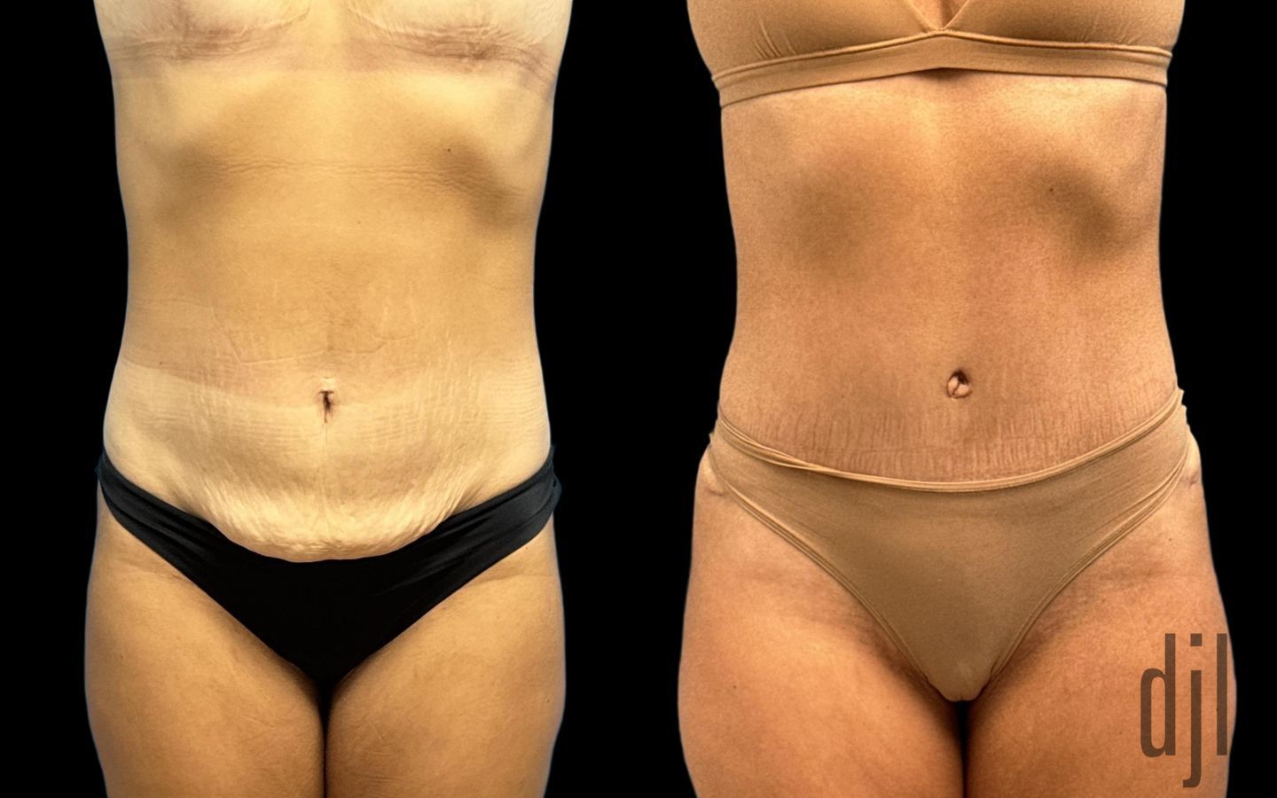 Before and after Tummy Tuck case 33056