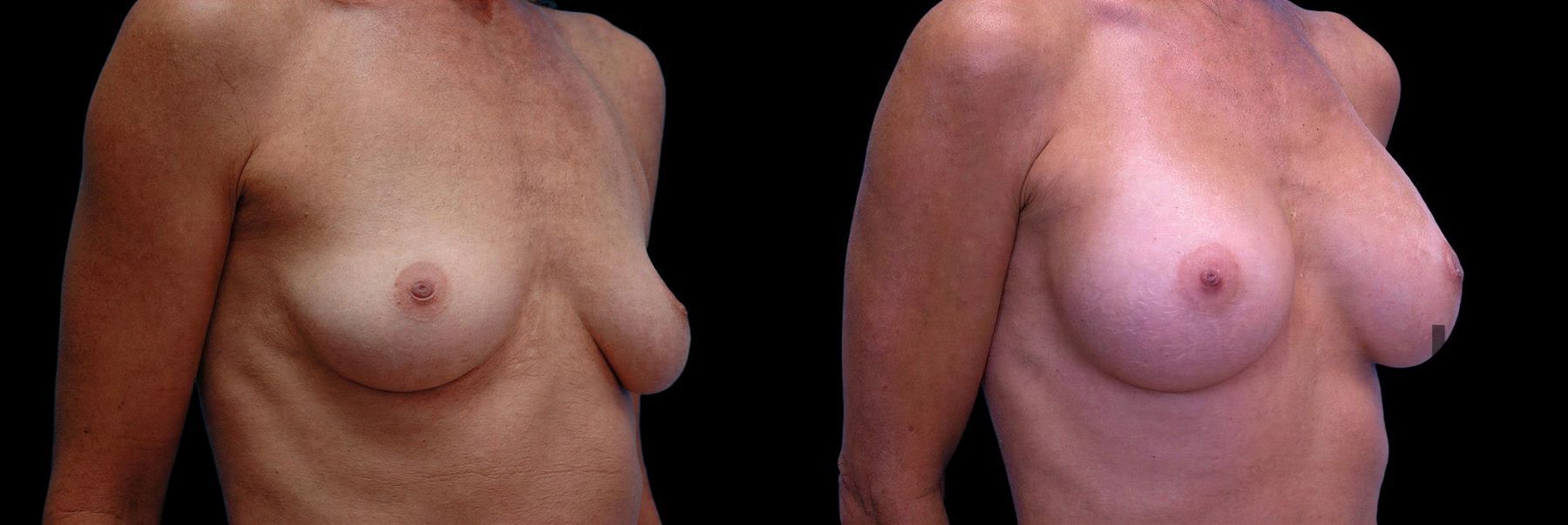 Before and after Breast Augmentation case 42867 - Angle 2