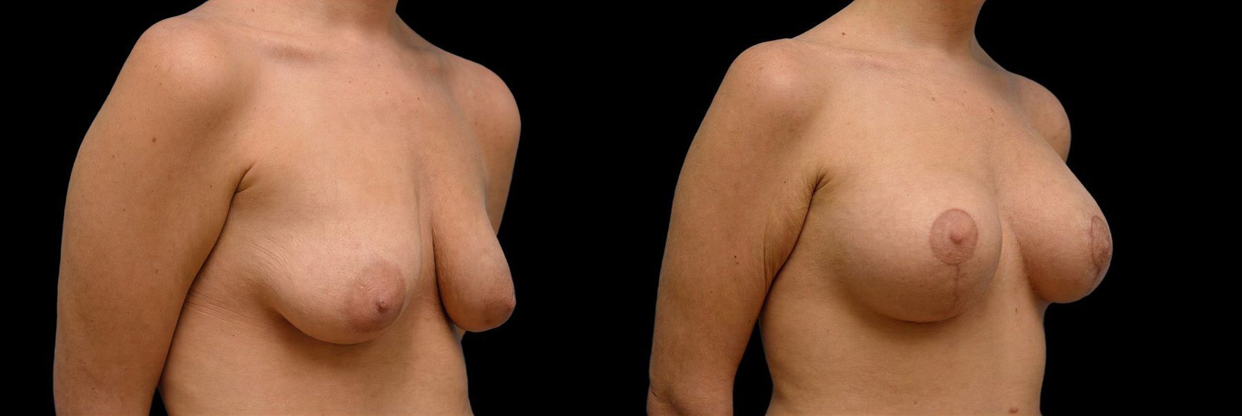 Before and after Breast Augmentation with Lift case 42769 - Angle 2