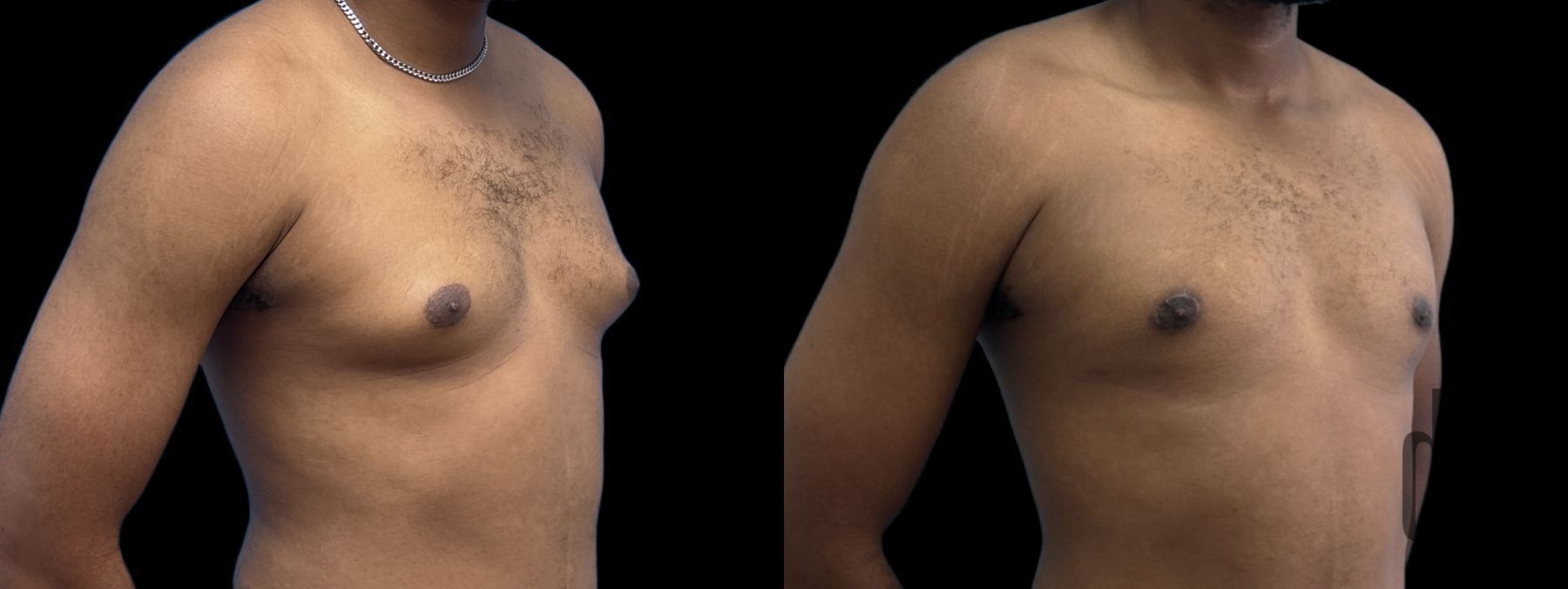 Before and after Gynecomastia case 37379 - Angle 2