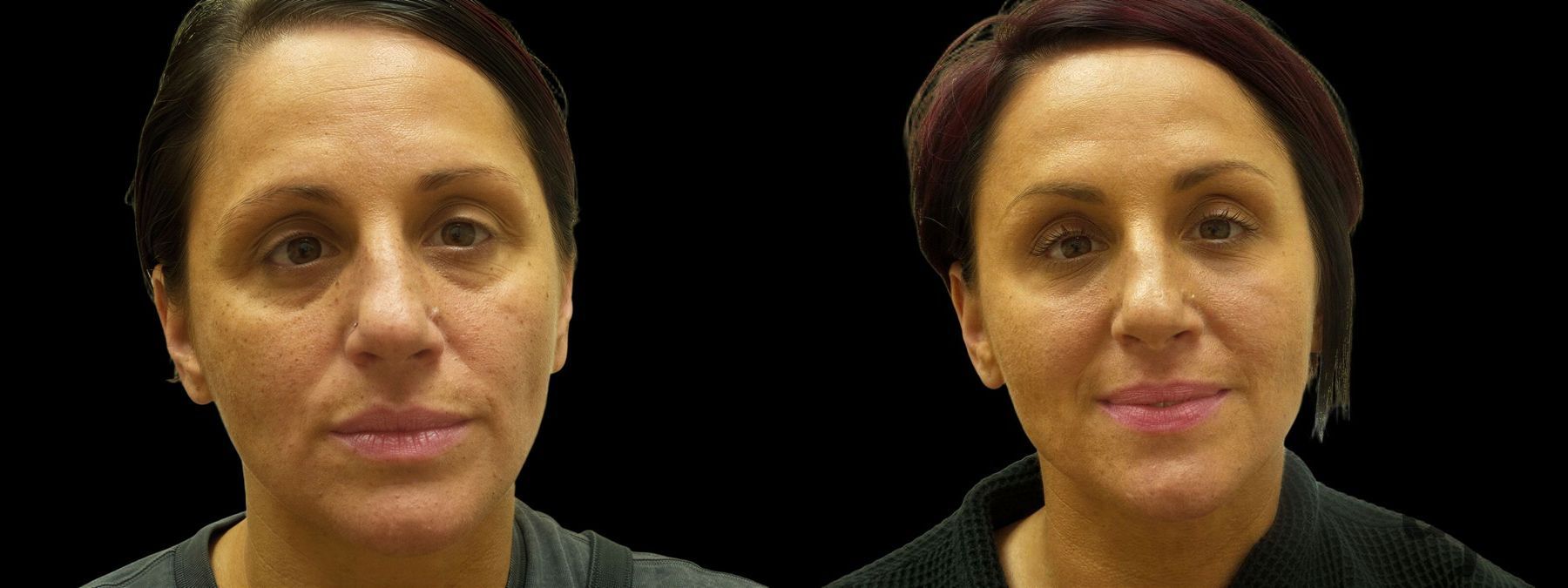 Before and after Suborbital / Tear Trough case 42604 - Angle 2