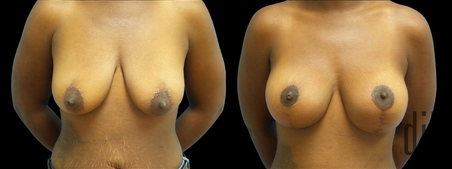 Before and after Breast Augmentation with Lift case 42914